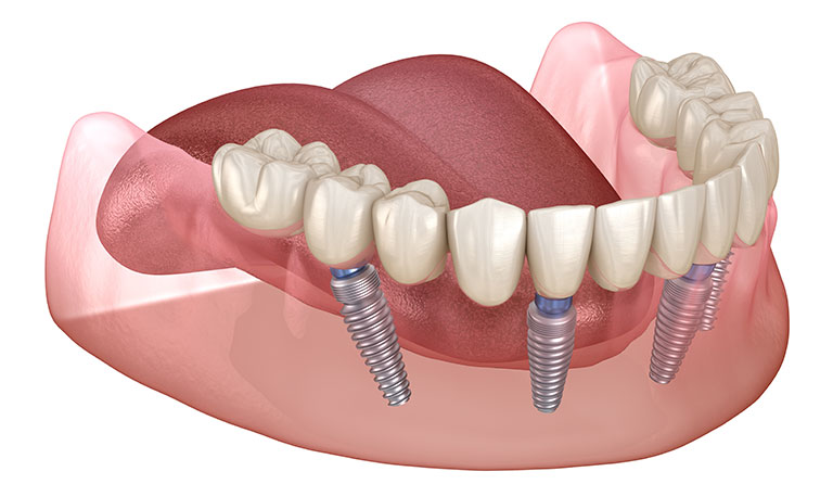 Full-arch dental implants