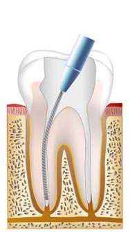 Root canal procedure step 2
