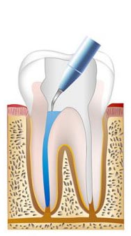 Root canal procedure step 3