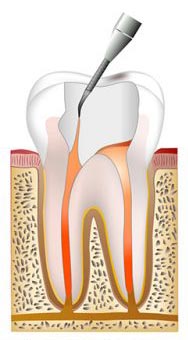 Root canal procedure step 4