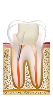 Root canal procedure step 5