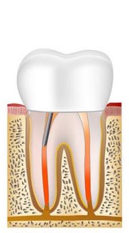 Root canal procedure step 6